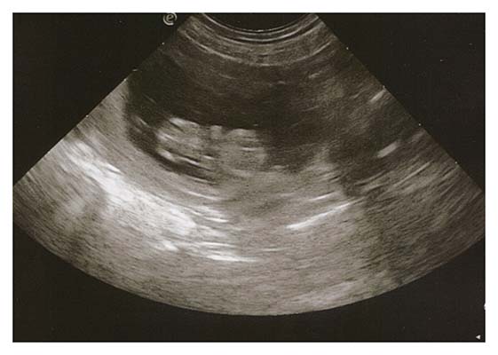 Sonogram1